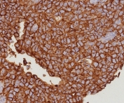 IHC staining of FFPE human bladder tissue with EpCAM antibody (clone EGP40/8191R). HIER: boil tissue sections in pH 9 10mM Tris with 1mM EDTA for 20 min and allow to cool before testing.