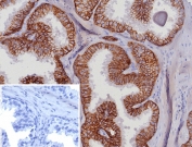 IHC staining of FFPE human prostate carcinoma tissue with EpCAM antibody (clone EGP40/8191R). Inset: PBS used in place of primary Ab (secondary Ab negative control). HIER: boil tissue sections in pH 9 10mM Tris with 1mM EDTA for 20 min and allow to cool before testing.