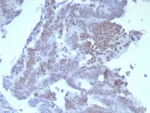 IHC staining of FFPE human colon carcinoma tissue with SATB2 antibody (clone SATB2/8264R). HIER: boil tissue sections in pH 9 10mM Tris with 1mM EDTA for 20 min and allow to cool before testing.