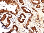IHC staining of FFPE human prostate tissue with IDH1-R132H mutation with IDH1-R132H antibody (clone IDH1.R132H/7328R). HIER: boil tissue sections in pH 9 10mM Tris with 1mM EDTA for 20 min and allow to cool before testing.
