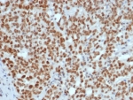 IHC staining of FFPE human Lynch disease colon tissue with MutL Homolog 1 antibody (clone MLH1/7560). HIER: boil tissue sections in pH 9 10mM Tris with 1mM EDTA for 20 min and allow to cool before testing.