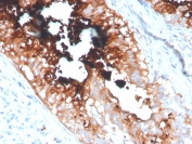 IHC staining of FFPE human breast carcinoma tissue with LTF antibody (clone LTF/4077). HIER: boil tissue sections in pH 9 10mM Tris with 1mM EDTA for 20 min and allow to cool before testing.