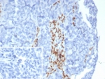IHC staining of FFPE human ovarian carcinoma tissue with Forkhead box protein L2 antibody (clone FOXL2/8362R). Inset: PBS used in place of primary Ab (secondary Ab negative control). HIER: boil tissue sections in pH 9 10mM Tris with 1mM EDTA for 20 min and allow to cool before testing.