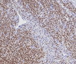 IHC staining of FFPE human ovarian adult granulosa cell tumor tissue with recombinant FOXL2 antibody (clone FOXL2/7989R). HIER: boil tissue sections in pH 9 10mM Tris with 1mM EDTA for 20 min and allow to cool before testing.