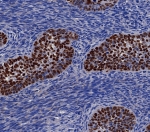 IHC staining of FFPE human lung carcinoma tissue with p40 antibody (clone P40/8225R). HIER: boil tissue sections in pH 9 10mM Tris with 1mM EDTA for 20 min and allow to cool before testing.