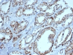 IHC staining of FFPE human prostate carcinoma tissue with p504S antibody (clone AMACR/4757). HIER: boil tissue sections in pH 9 10mM Tris with 1mM EDTA for 20 min and allow to cool before testing.