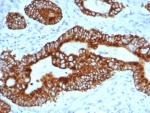 IHC staining of FFPE human colon carcinoma tissue with p504S antibody (clone AMACR/4757). HIER: boil tissue sections in pH 9 10mM Tris with 1mM EDTA for 20 min and allow to cool before testing.
