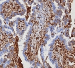 IHC staining of FFPE human serous ovarian carcinoma with MITA antibody (clone STING1/8129R). HIER: boil tissue sections in pH 9 10mM Tris with 1mM EDTA for 20 min and allow to cool before testing.
