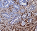 IHC staining of FFPE human prostate carcinoma tissue with MITA antibody (clone STING1/8129R). HIER: boil tissue sections in pH 9 10mM Tris with 1mM EDTA for 20 min and allow to cool before testing.