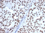 IHC staining of FFPE human breast carcinoma tissue with Heat shock 70 kDa protein 1B antibody (clone HSPA1B/7628). HIER: boil tissue sections in pH 9 10mM Tris with 1mM EDTA for 20 min and allow to cool before testing.