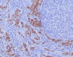 IHC staining of FFPE human lung carcinoma tissue with ROS1 antibody (clone ROS1/7999R). HIER: boil tissue sections in pH 9 10mM Tris with 1mM EDTA for 20 min and allow to cool before testing.