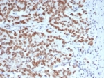 IHC staining of FFPE human Lynch syndrome colon carcinoma tissue with Enhancer of zeste homolog 2 antibody (clone EZH2/6988). HIER: boil tissue sections in pH 9 10mM Tris with 1mM EDTA for 20 min and allow to cool before testing.