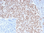 IHC staining of FFPE human Lynch disease colon tissue with Enhancer of zeste homolog 2 antibody (clone EZH2/4687). HIER: boil tissue sections in pH 9 10mM Tris with 1mM EDTA for 20 min and allow to cool before testing.
