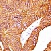 IHC testing of FFPE human colon carcinoma and EpCAM antibody (EPM17-1). FFPE testing requires sections to be boiled in pH 9 10mM Tris with 1mM EDTA for 10-20 minutes, followed by cooling at RT for 20 minutes, prior to staining.