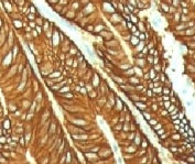 IHC testing of FFPE human colon carcinoma and EpCAM antibody (EPM17-1). FFPE testing requires sections to be boiled in pH 9 10mM Tris with 1mM EDTA for 10-20 minutes, followed by cooling at RT for 20 minutes, prior to staining.