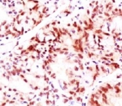 IHC testing of ovarian cancer stained with Estrogen Receptor beta antibody (clone NR3Gb-1).