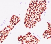 IHC testing of human breast carcinoma stained with Estrogen receptor antibody (NR3Ga-3). FFPE testing requires boiling tissue sections in pH 9 10mM Tris with 1mM EDTAfor 10-20 min and cooling at RT for 20 minutes.