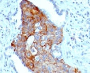IHC testing of FFPE human lung squamous cell carcinoma and TRIM29 antibody (clone TPMP29-1). FFPE testing requires sections to be boiled in pH 9 10mM Tris with 1mM EDTA for 10-20 minutes, followed by cooling at RT for 20 minutes, prior to staining.