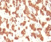 IHC testing of FFPE human thyroid carcinoma and Cytokeratin 18 antibody (clone CTKN18-1). FFPE testing requires sections to be boiled in pH 9 10mM Tris with 1mM EDTA for 10-20 min, followed by cooling at RT for 20 min, prior to staining.