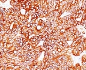 IHC testing of FFPE human colon carcinoma and Cytokeratin 18 antibody (clone CTKN18-1). FFPE testing requires sections to be boiled in pH 9 10mM Tris with 1mM EDTA for 10-20 min, followed by cooling at RT for 20 min, prior to staining.