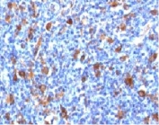 IHC testing of FFPE Hodgkin's lymphoma with Fascin antibody (clone FAN55-1). Staining of formalin-fixed tissues requires boiling tissue sections in pH 9 10mM Tris with 1mM EDTA for 10-20 min followed by cooling at RT for 20 min.