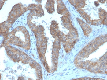 IHC staining of FFPE human prostate carcinoma with CD47 antibody (clone CD47/3019). HIER: boil tissue sections in pH 9 10mM Tris with 1mM EDTA for 10-20 min and allow to cool before testing.~