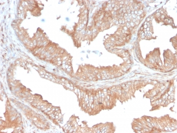 IHC staining of FFPE human prostate carcinoma