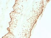 IHC staining of FFPE human cervical carcinoma with recombinant SOX2 antibody (clone SOX2/3811R). HIER: boil tissue sections in pH 9 10mM Tris with 1mM EDTA for 10-20 min and allow to cool before testing.