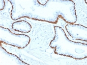 IHC staining of FFPE human prostate carcinoma with Cytokeratin 5 antibody (clone KRT5/2080). HIER: boil tissue sections in pH 9 10mM Tris with 1mM EDTA for 20 min and allow to cool before testing.