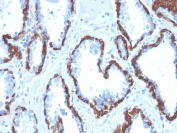 IHC staining of FFPE human prostate carcinoma with Cytokeratin 13 antibody (clone KRT13/2659). HIER: boil tissue sections in pH 9 10mM Tris with 1mM EDTA for 20 min and allow to cool before testing.