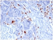 IHC staining of FFPE human ovarian carcinoma with SREBP1 antibody (clone SREBP1/1578). HIER: boil tissue sections in pH 9 10mM Tris with 1mM EDTA for 20 min and allow to cool before testing. Negative control inset: PBS used instead of primary antibody to control for secondary Ab binding.