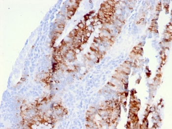 IHC staining of FFPE human colon carcinoma with DR5 antibody. HIER: boil tissue sections in pH 9 10mM Tris with 1mM EDTA for 20 min and allow to cool before testing.