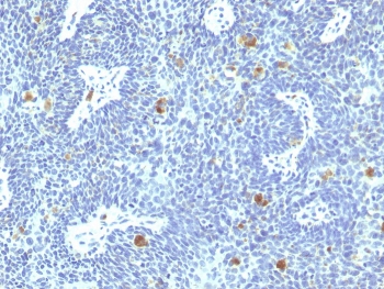 IHC staining of FFPE human cervix with HPV-16 E6 antibody. HIER: boil tissue sections in pH 9 10mM Tris with 1mM EDTA for 20 min and allow to cool before testing.~
