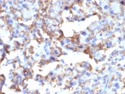 IHC staining of FFPE human histiocytoma with CD163 antibody (clone M130/2163). HIER: boil tissue sections in pH 9 10mM Tris with 1mM EDTA for 20 min and allow to cool before testing.