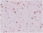 IHC staining of FFPE human glioblastoma tissue with IDH1-R132H antibody (clone IDH1/6806R). HIER: boil tissue sections in pH 9 10mM Tris with 1mM EDTA for 20 min and allow to cool before testing.