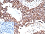 IHC staining of FFPE human ovarian carcinoma tissue with TREM2 antibody (clone TREM2/7210). Negative control inset: PBS instead of primary antibody to control for secondary binding. HIER: boil tissue sections in pH 9 10mM Tris with 1mM EDTA for 20 min and allow to cool before testing.