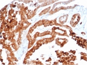 IHC staining of FFPE human renal carcinoma tissue with HAVCR2 antibody (clone TIM3/4024). HIER: boil tissue sections in pH 9 10mM Tris with 1mM EDTA for 20 min and allow to cool before testing.