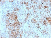 IHC staining of FFPE human lymph node tissue with HAVCR2 antibody (clone TIM3/4024). HIER: boil tissue sections in pH 9 10mM Tris with 1mM EDTA for 20 min and allow to cool before testing.