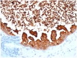 IHC staining of FFPE human prostate carcinoma tissue with Lactoferrin antibody (clone LTF/4075). Negative control inset: PBS instead of primary antibody to control for secondary binding. HIER: boil tissue sections in pH 9 10mM Tris with 1mM EDTA for 20 min and allow to cool before testing.
