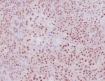 IHC staining of FFPE human adrenal cortical tumor tissue with recombinant SF-1 antibody (clone NR5A1/4368R). HIER: boil tissue sections in pH 9 10mM Tris with 1mM EDTA for 20 min and allow to cool before testing.