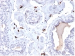 IHC staining of FFPE human breast carcinoma tissue with Fatty Acid Binding Protein 4 antibody (clone FABP4/4422). HIER: boil tissue sections in pH 9 10mM Tris with 1mM EDTA for 20 min and allow to cool before testing.