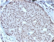IHC staining of FFPE human breast carcinoma tissue with HOXB2 antibody (clone PCRP-HOXB2-1F2) at 2ug/ml in PBS for 30min RT. HIER: boil tissue sections in pH 9 10mM Tris with 1mM EDTA for 20 min and allow to cool before testing.