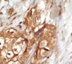IHC analysis of FFPE human breast carcinoma tissue stained with the NIK antibody