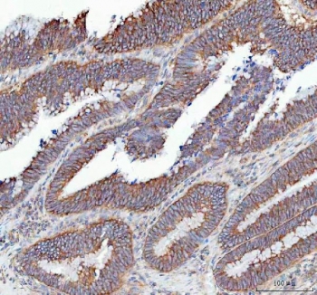 IHC staining of FFPE human colorectal adenocarcinoma tissue with SLC12A6 antibody. HIER: boil tissue sections in pH8 EDTA for 20 min and allow to cool before testing.