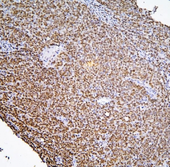 IHC staining of FFPE human sarcoma with BHC80 antibody. HIER: boil tissue sections in pH6, 10mM citrate buffer, for 20 min and allow to cool before testing.