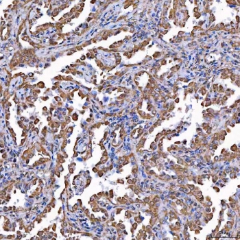 IHC staining of FFPE human lung cancer tissue with TOMM34 antibody. HIER: boil tissue sections in pH8 EDTA for 20 min and allow to cool before testing.
