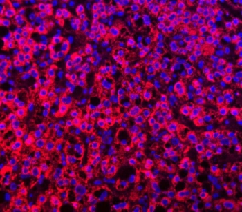 Immunofluorescent staining of FFPE human liver cancer with TTLL2 antibody (red) and DAPI nuclear stain (blue). HIER: steam section in pH8 EDTA buffer for 20 min.