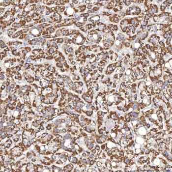 IHC staining of FFPE human liver cancer tissue with Thyroxine Binding Globulin antibody. HIER: boil tissue sections in pH8 EDTA for 20 min and allow to cool before testing.