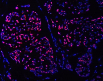 Immunofluorescent staining of FFPE human breast cancer tissue with SMC6 antibody (red) and DAPI nuclear stain (blue). HIER: steam section in pH8 EDTA buffer for 20 min.