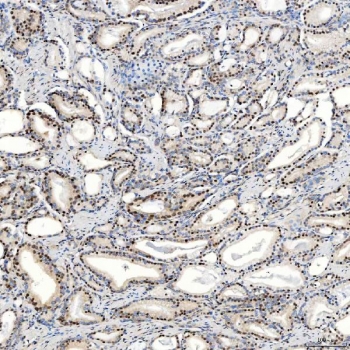IHC staining of FFPE human prostate adenocarcinoma tissue with U1 snRNP C antibody. HIER: boil tissue sections in pH8 EDTA for 20 min and allow to cool before testing.